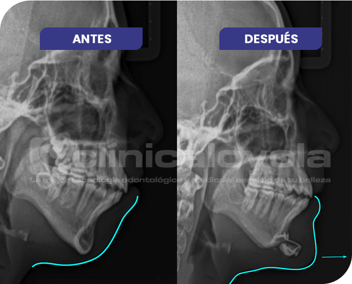 2024_Oct_CasoExito_1_MentoplastiaDeAvance2