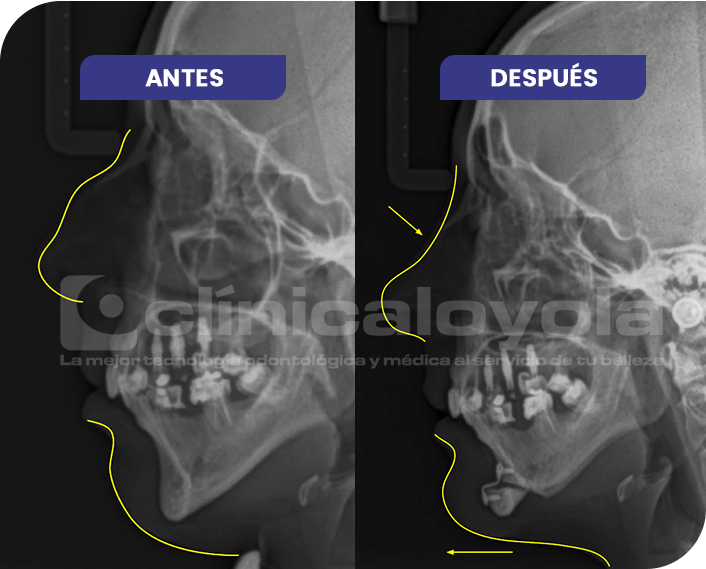 2024_Oct_CasoExito_2_Rinoplastia_Mentoplastia2