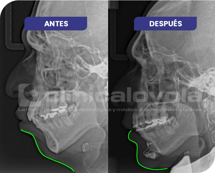 2024_Oct_CasoExito_4_Cirugia_Ortognatica_Maxilar2