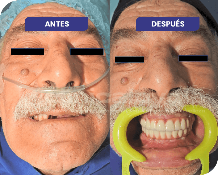 implantes dentales antes y después Clinica Loyola