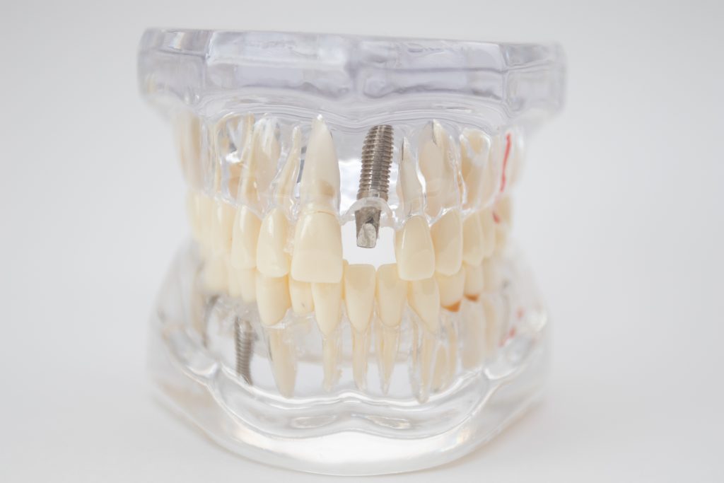 Ejemplo de implante dental