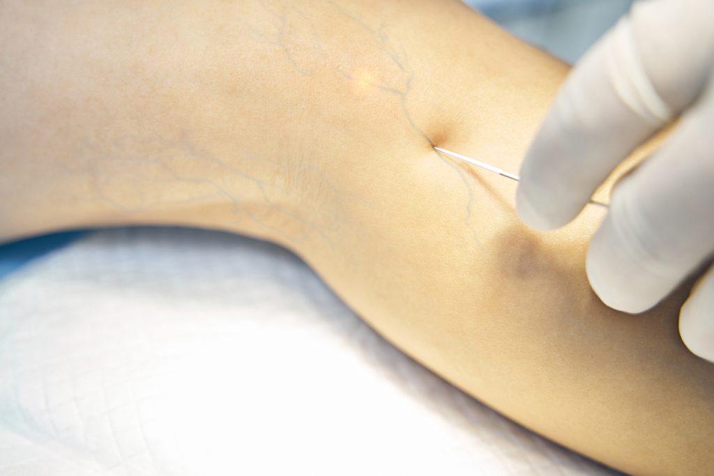 Procedimiento de escleroterapia