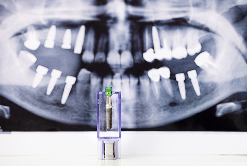 radiografía de implantes dentales