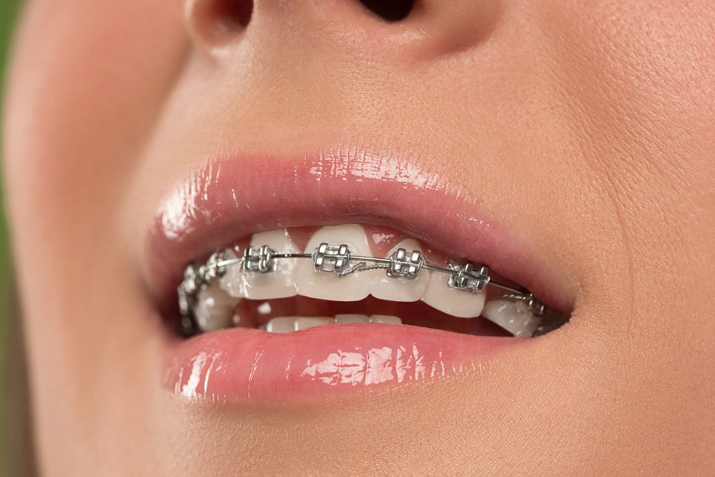 brackets en diseño de sonrisa