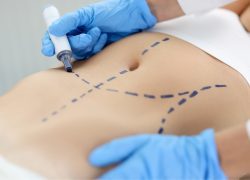 Abdominoplastia