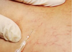 Primer plano escleroterapia