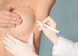 Mamoplastia