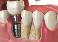 procedimiento de implantes dentales
